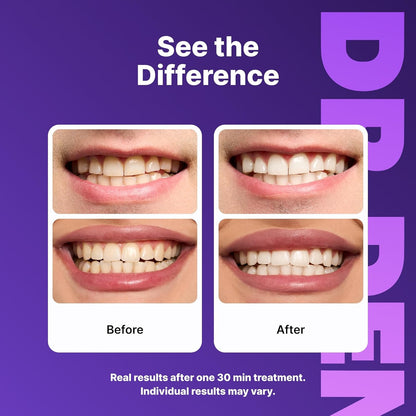 Teeth Whitening Strips